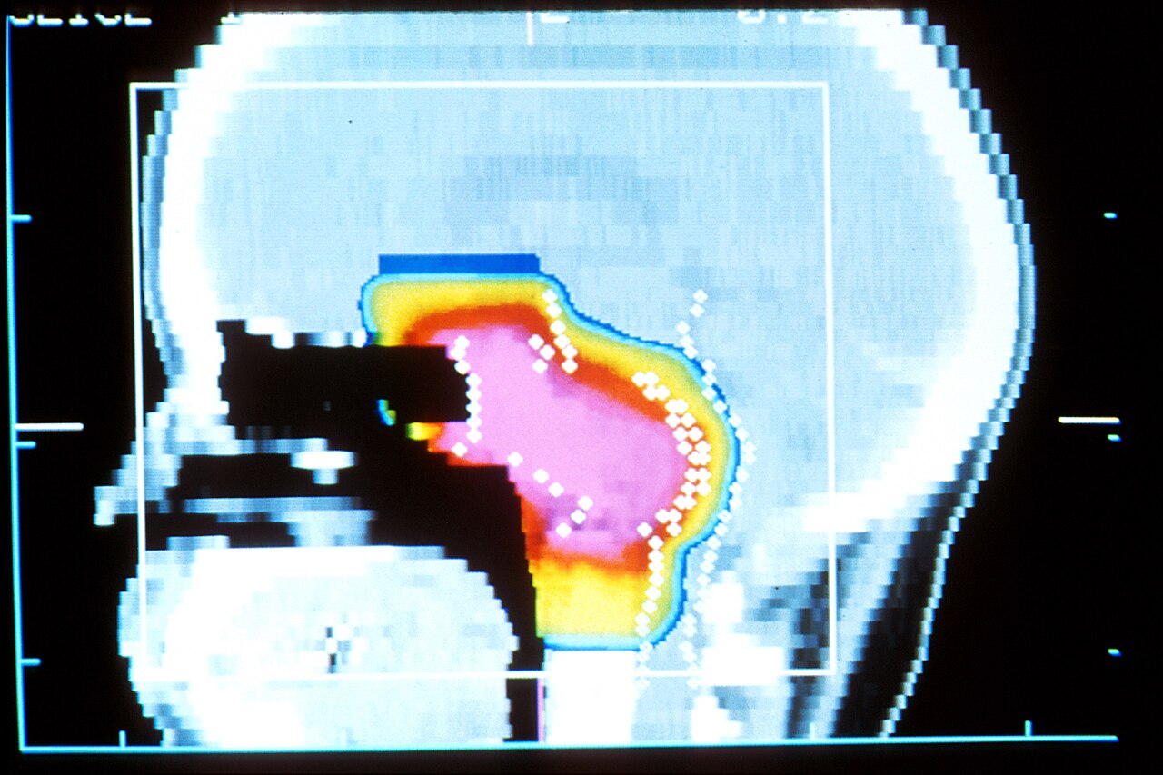 Acceleratore per adroterapia