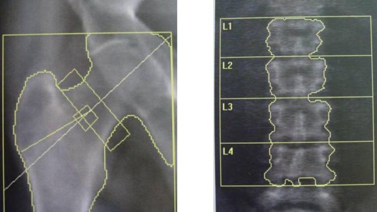 Radiografia della colonna