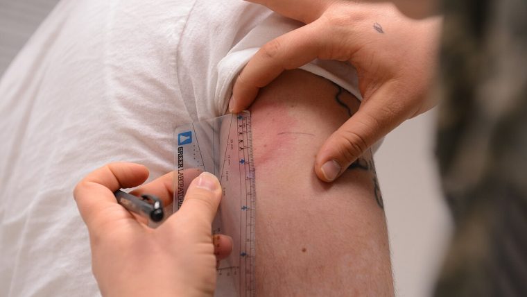 Reazione allergica sulla pelle
