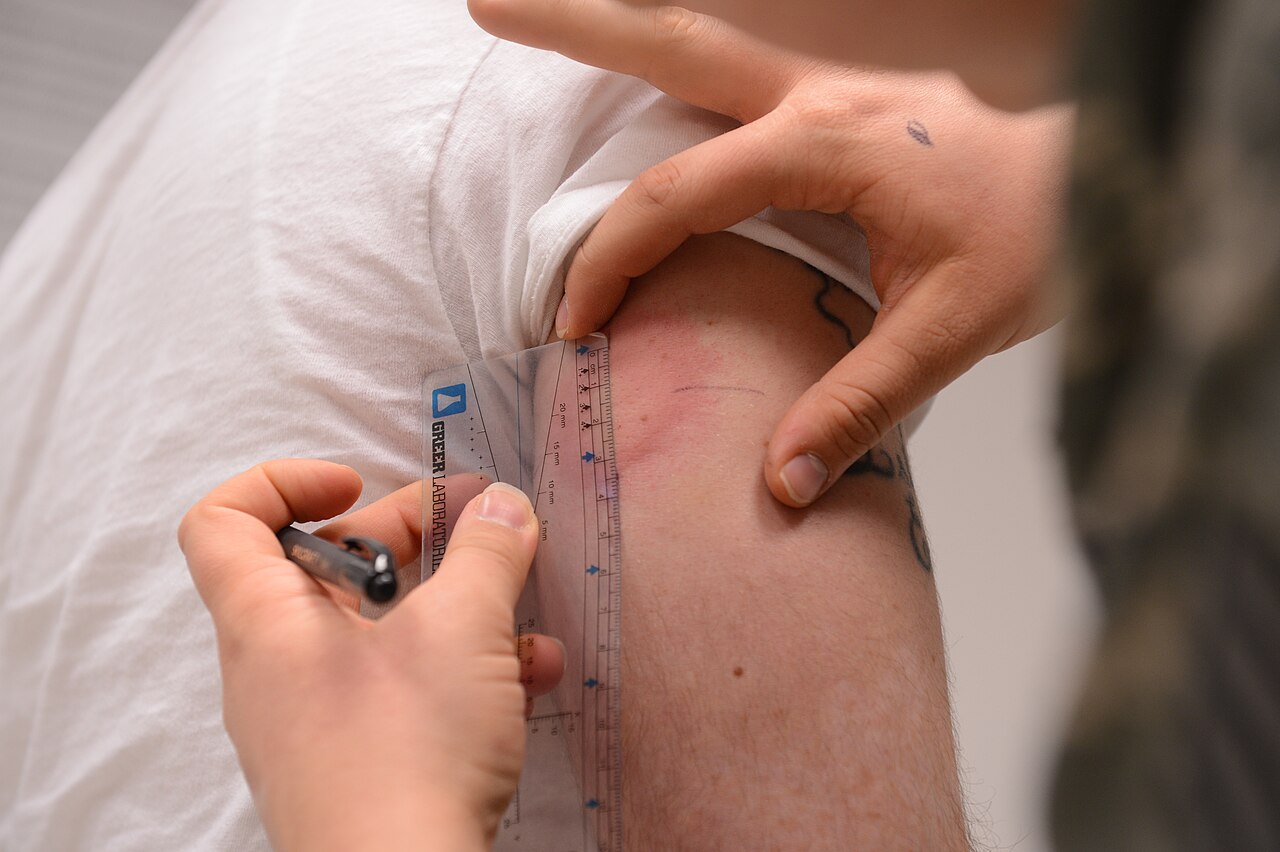 Reazione allergica sulla pelle