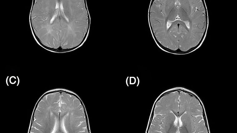 Risonanza magnetica del cervello