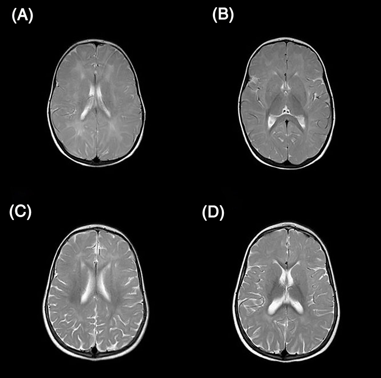 Risonanza magnetica del cervello