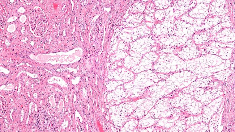 Cellule tumorali al microscopio