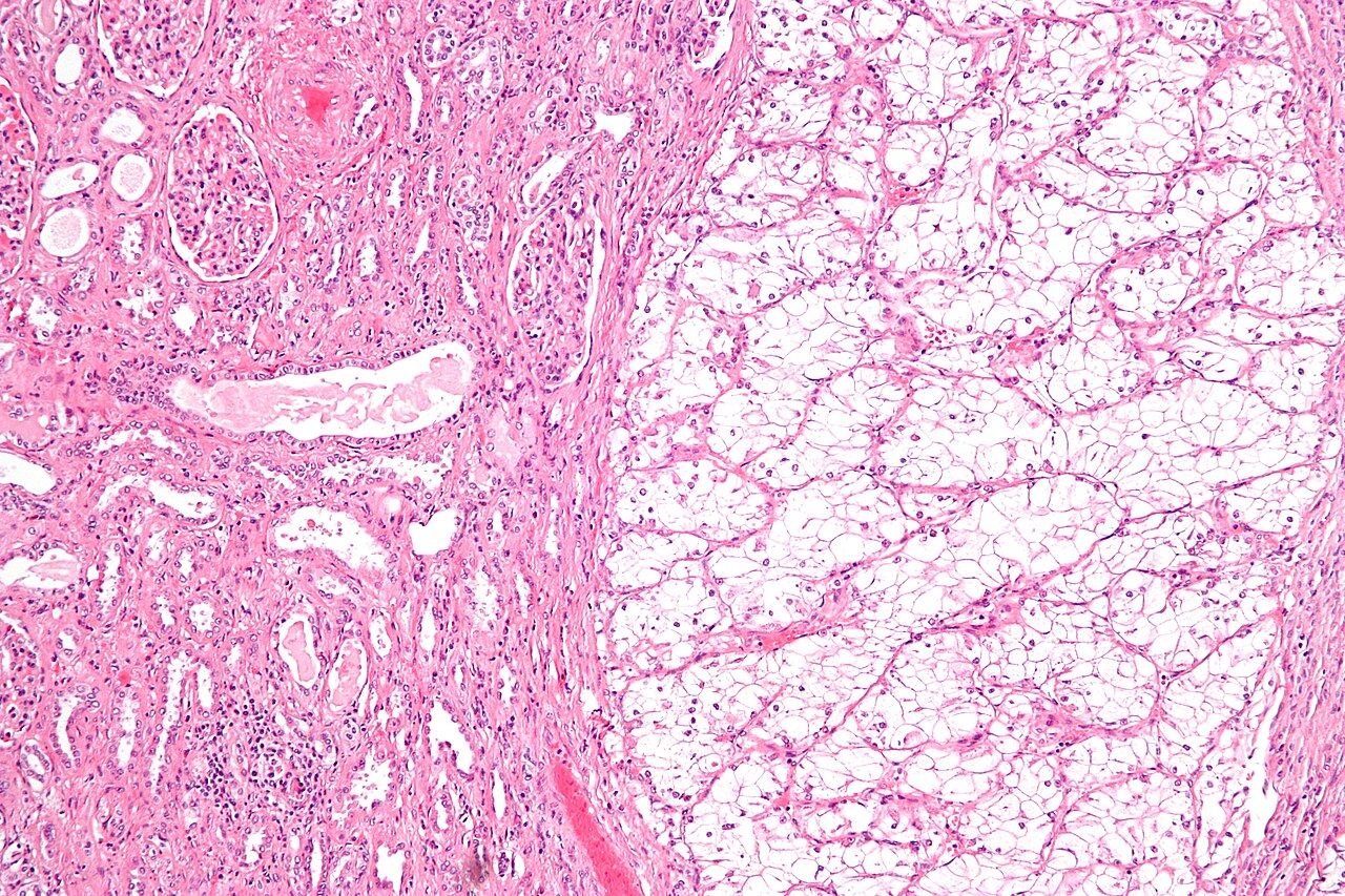 Cellule tumorali al microscopio