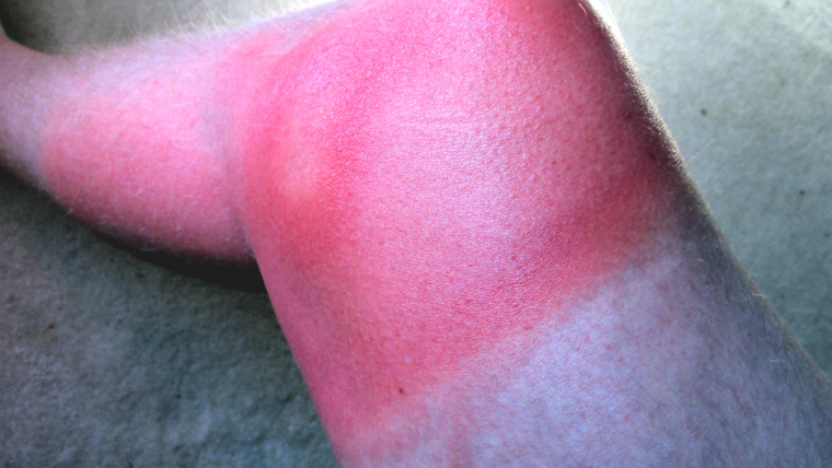 Scottatura solare