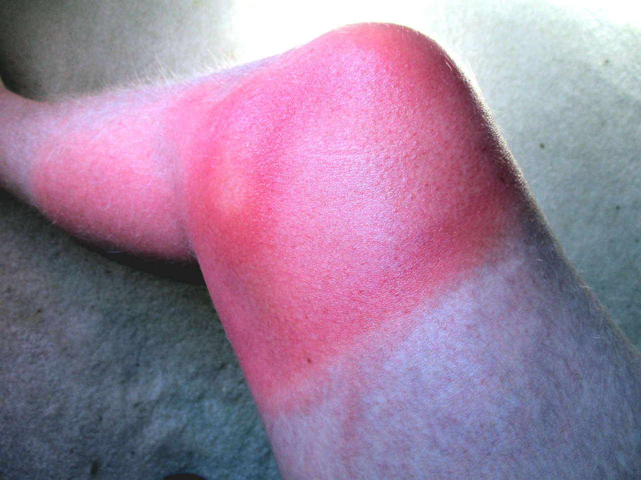 Scottatura solare