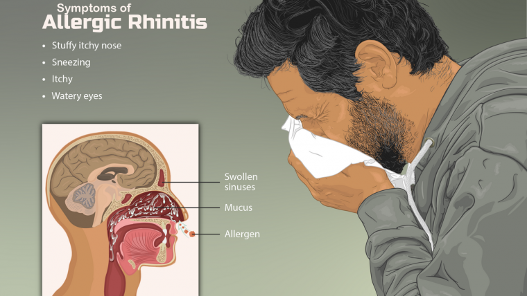 Rinite allergica