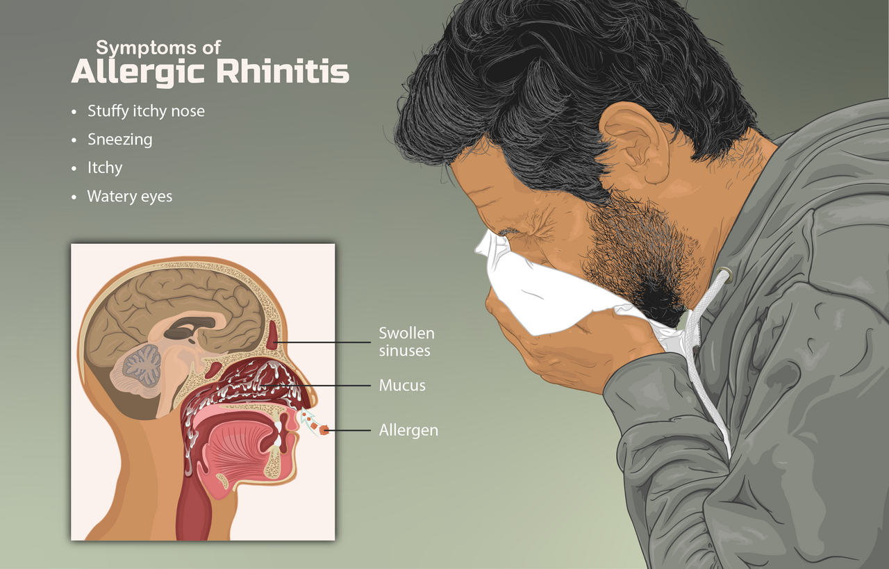 Rinite allergica