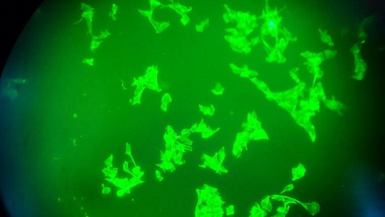 Cellule tumorali al microscopio