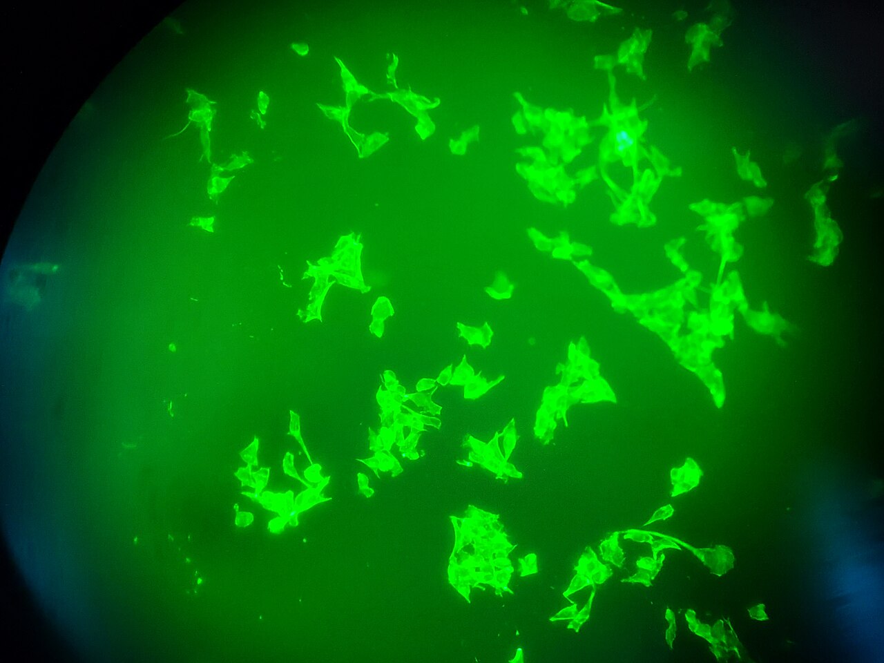 Cellule tumorali al microscopio