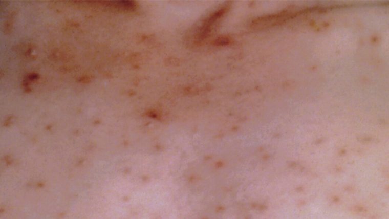 Varicella