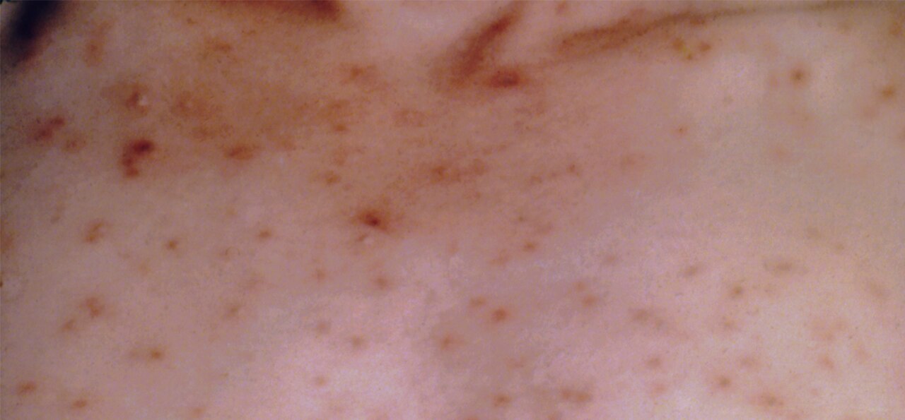 Varicella
