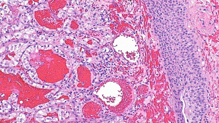 Cellule tumorali al microscopio