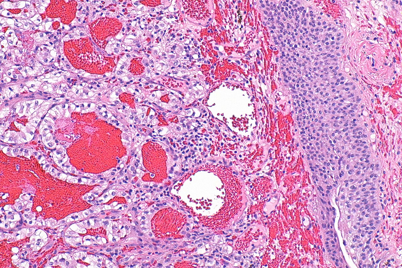 Cellule tumorali al microscopio